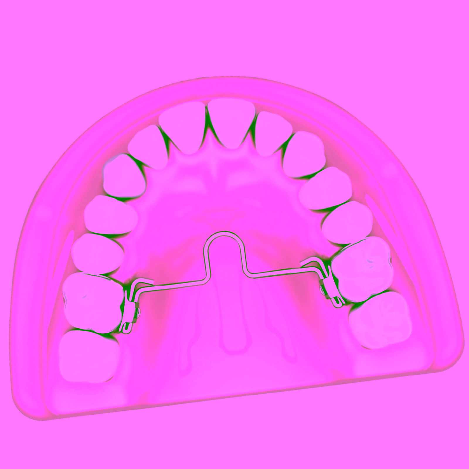 Barra palatina ortodóncica con loop mesial