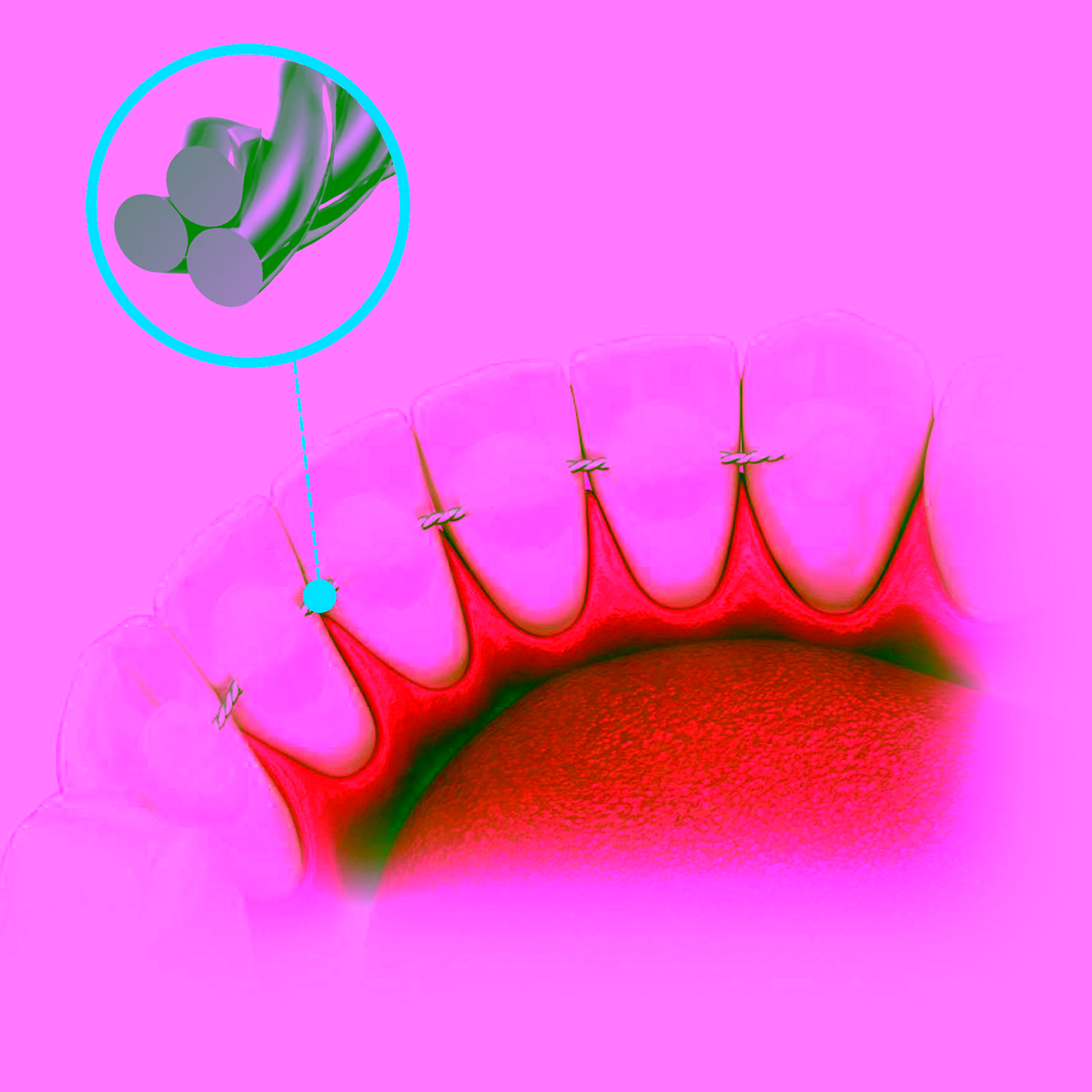Contención TwistForm 3x3 Ø0,65mm